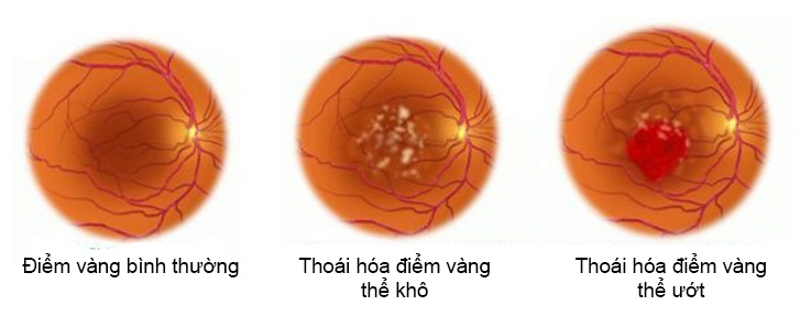 Age-related Macular Degeneration - Ảnh minh họa 2