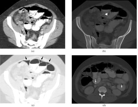 Lymphoma ruột non - Ảnh minh họa 4