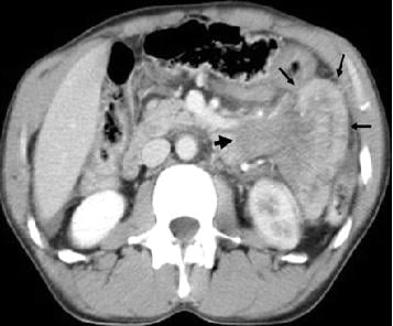 Lymphoma ruột non - Ảnh minh họa 5