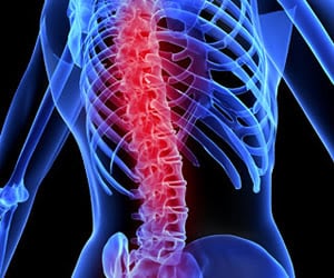 Acute Spinal Cord Injury - Ảnh minh họa 3