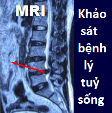 Acute Spinal Cord Injury - Ảnh minh họa 4