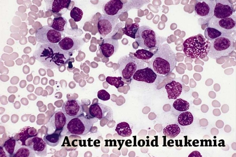 Acute myeloid leukemia (ALL) - Ảnh minh họa 2