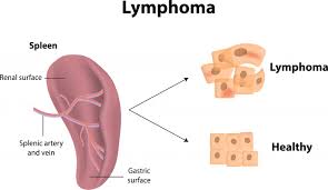 Lymphatic obstruction - Ảnh minh họa 3