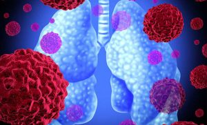 Atypical pneumonia - Ảnh minh họa 4