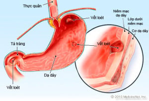 Loét tiêu hóa - Ảnh minh họa 5