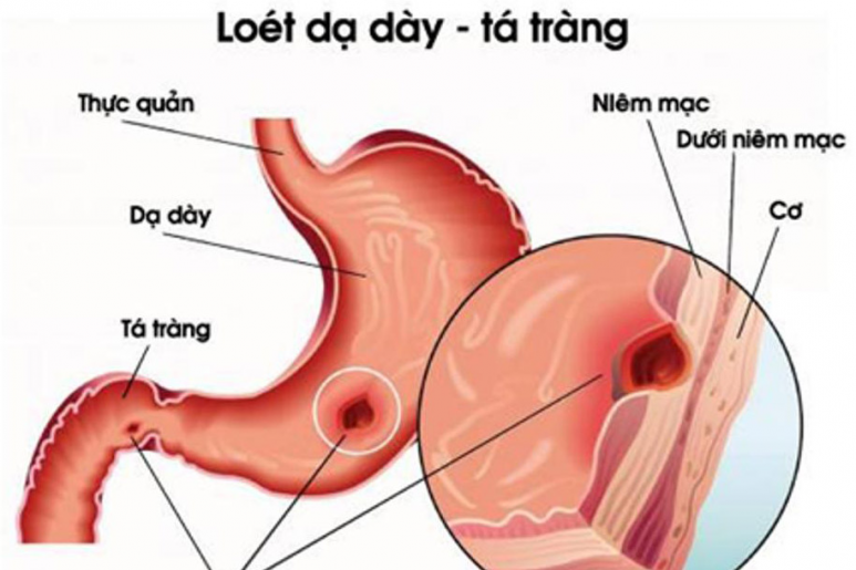 Loét dạ dày - Ảnh minh họa 5