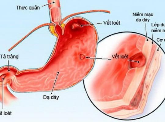 Acute gastritis - Ảnh minh họa 3