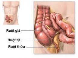 Appendicitis - Ảnh minh họa 3