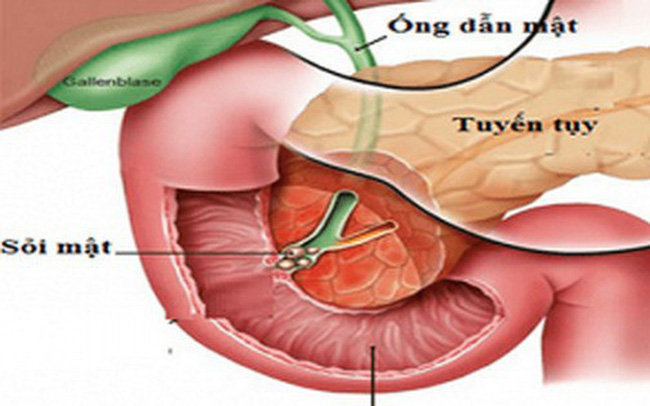 Acute pancreatitis - Ảnh minh họa 3