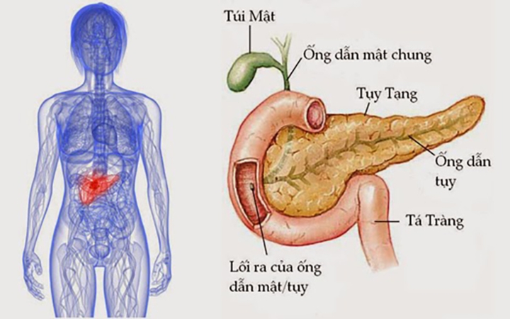 Acute pancreatitis - Ảnh minh họa 2