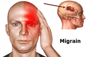 Migraine - Ảnh minh họa 5