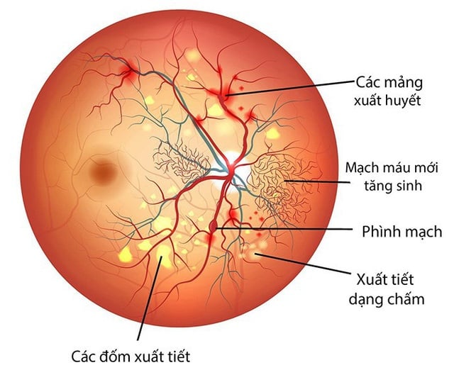 Mạch máu võng mạc - Ảnh minh họa 1