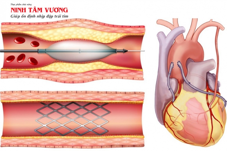 Mạch vành - Ảnh minh họa 3