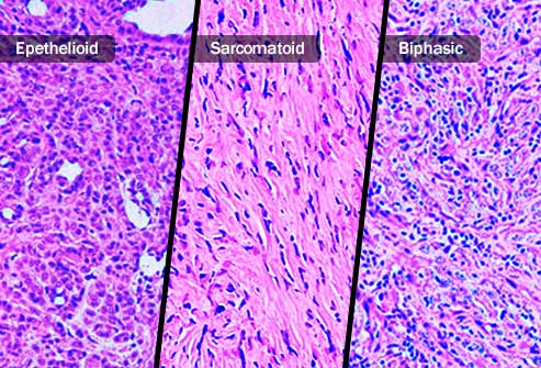 Malignant Mesothelioma - Ảnh minh họa 1