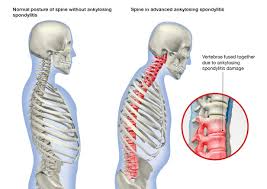 Ankylosing Spondylitis - Ảnh minh họa 2