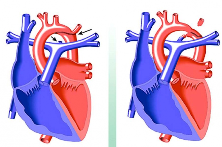 Aortic Stenosis - Ảnh minh họa 1