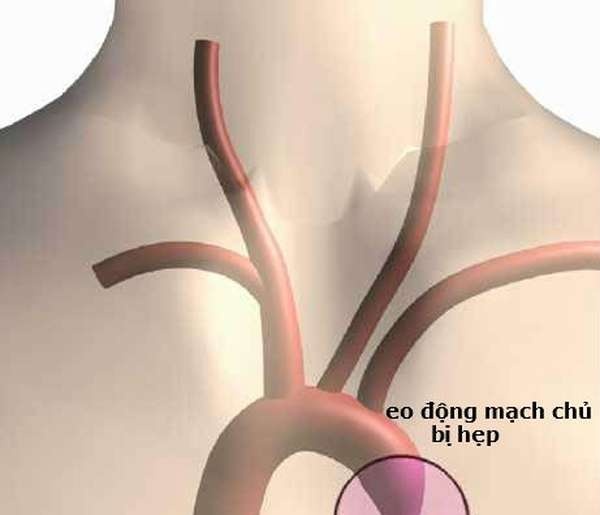 Aortic Stenosis - Ảnh minh họa 2