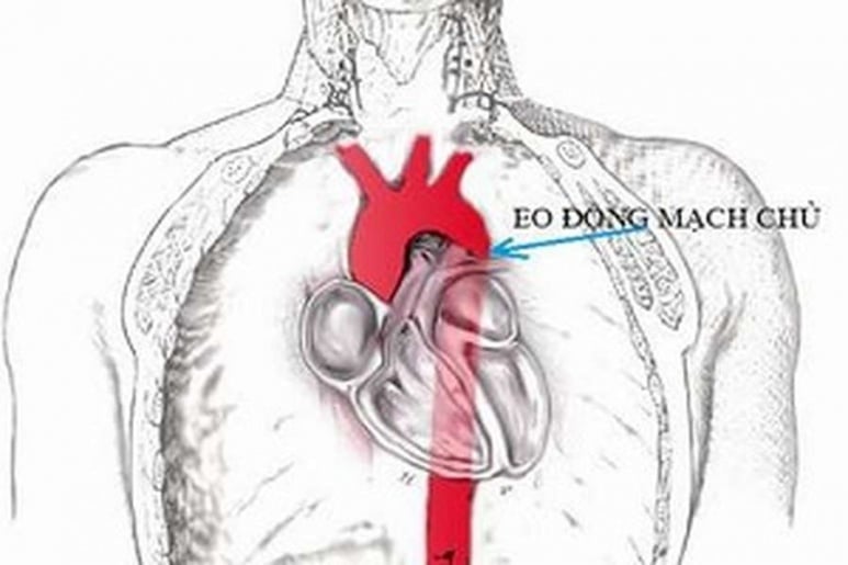 Aortic Stenosis - Ảnh minh họa 3