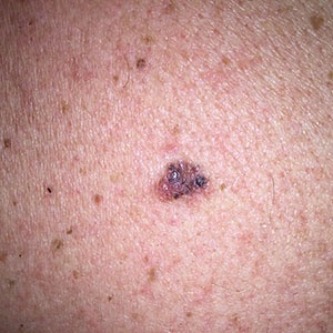 Malignant melanoma - Ảnh minh họa 2