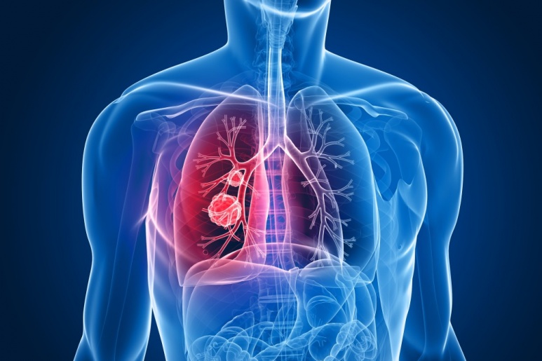 Malignant Mesothelioma - Ảnh minh họa 5