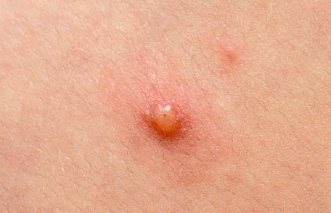 Molluscum contagiosum - Ảnh minh họa 1