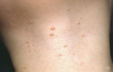 Molluscum contagiosum - Ảnh minh họa 4