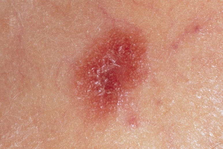 Malignant melanoma - Ảnh minh họa 3