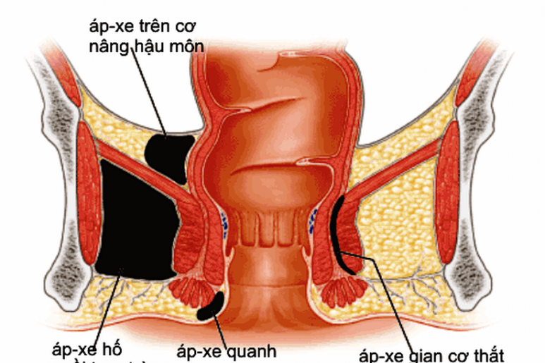 Áp xe trực tràng - Ảnh minh họa 2