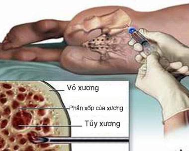 Multiple Myeloma - Ảnh minh họa 1