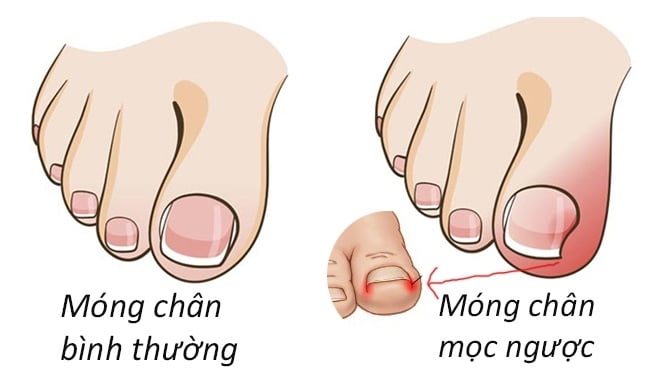 Móng mọc ngược - Ảnh minh họa 2