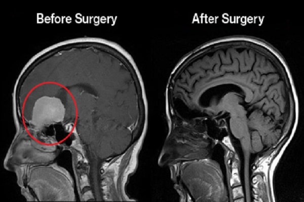 Meningiomas - Ảnh minh họa 1