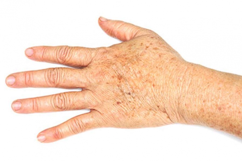 Actinic Keratosis - Ảnh minh họa 2