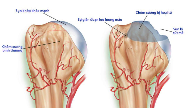 Avascular Necrosis - Ảnh minh họa 1