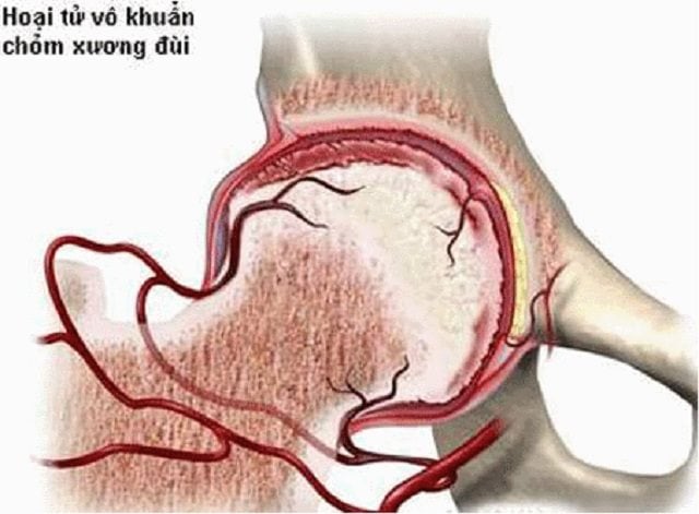 Avascular Necrosis - Ảnh minh họa 2