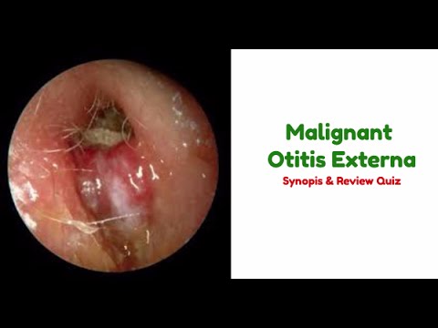 Malignant otitis externa - Ảnh minh họa 4