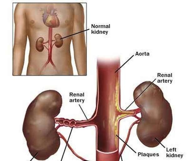 Arterial Embolism and Thrombosis - Ảnh minh họa 1