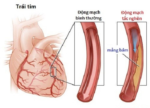 Mạch vành - Ảnh minh họa 5