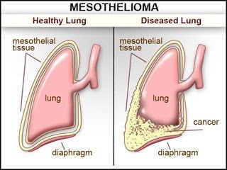 Malignant Mesothelioma - Ảnh minh họa 4