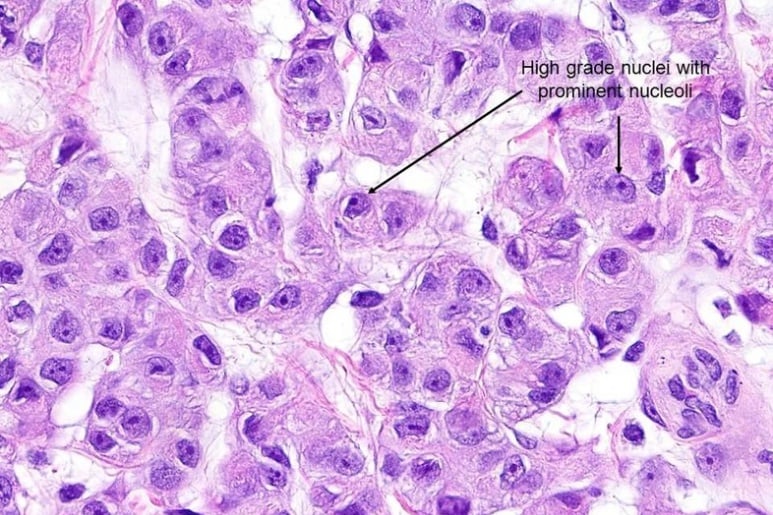 Malignant Mesothelioma - Ảnh minh họa 3