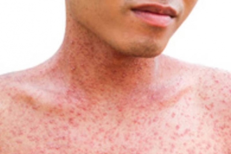 Measles - Ảnh minh họa 5