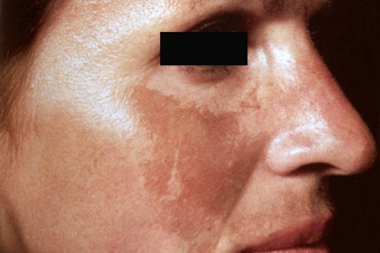 Melasma - Ảnh minh họa 3