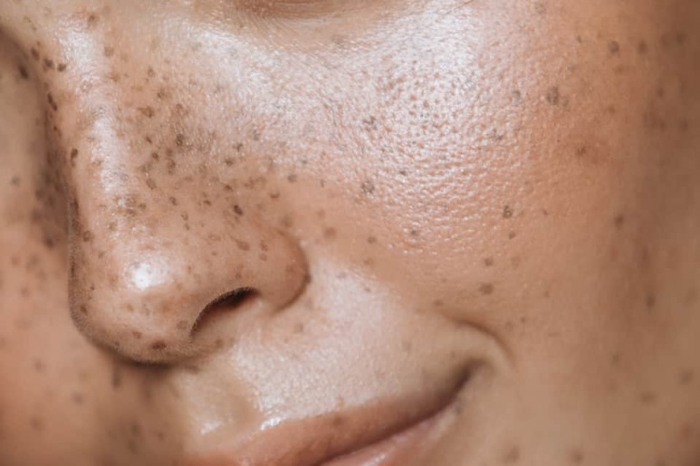 Melasma - Ảnh minh họa 2