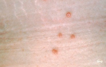 Molluscum contagiosum - Ảnh minh họa 3