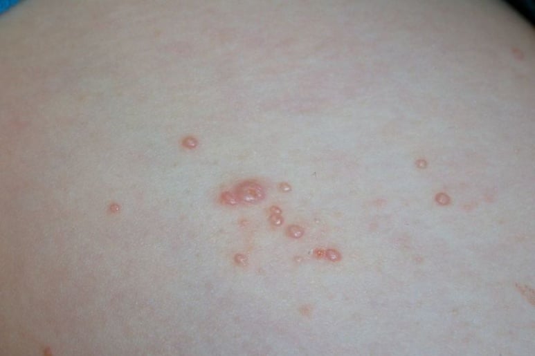 Molluscum contagiosum - Ảnh minh họa 2