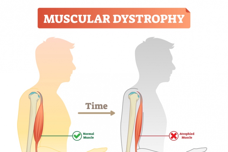 Muscular Dystrophy - Ảnh minh họa 3