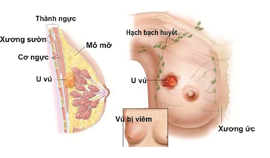 Mastitis - Ảnh minh họa 3