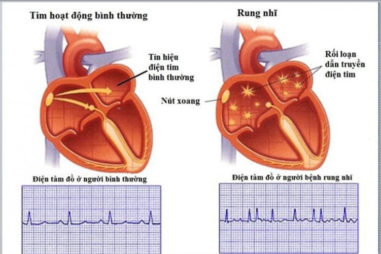 Atrial Fibrillation - Ảnh minh họa 1