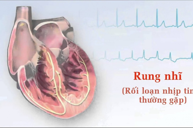 Atrial Fibrillation - Ảnh minh họa 3