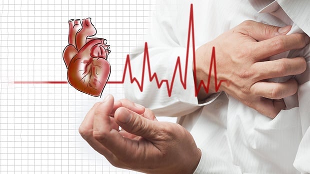 Atrial Fibrillation - Ảnh minh họa 2