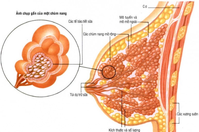 Mastitis - Ảnh minh họa 4